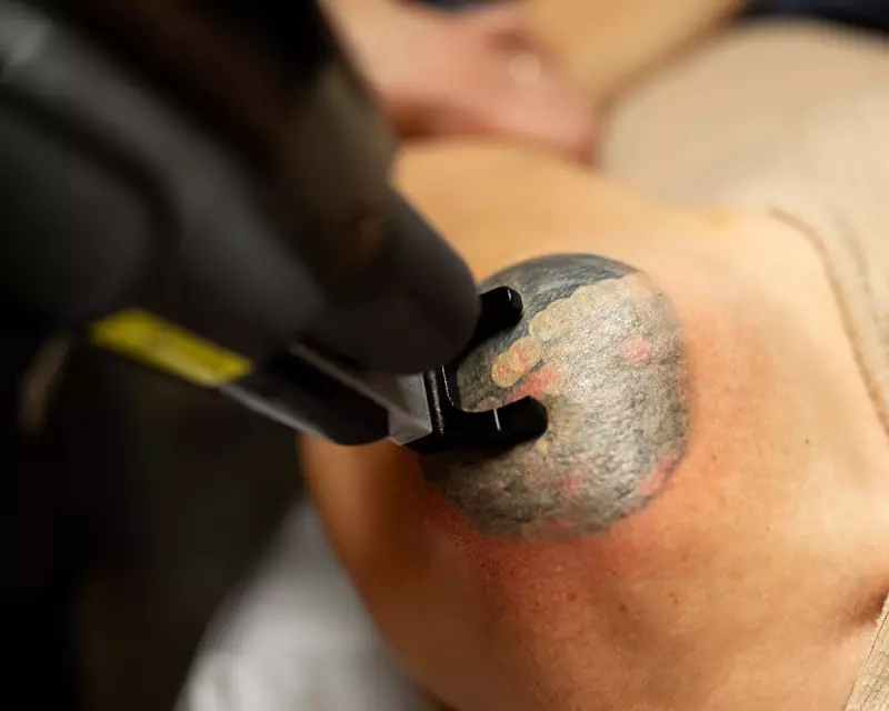 Tattoo Removal Gives Australians Second Chance From Gang Signs to Nazi Symbols