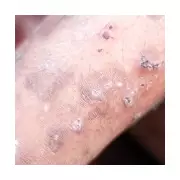 Scabies Outbreak Hits Devon Schools: Flesh-Crawling Symptoms Reported