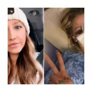 Woman's nose rebuilt using forehead skin after dog attack