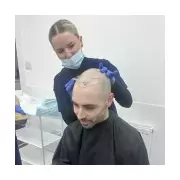 Hair Transplant at 34: My Journey to Regaining Confidence