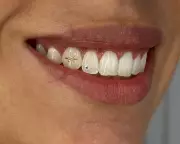 Tooth Gems Sparkle in Australia: A Trendy Grin or Dental Danger?