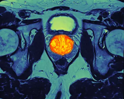 NHS England Expands Prostate Cancer Drug, Set to Save Thousands of Lives