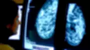 AI Mammography Study Shows Drop in Aggressive Breast Cancers