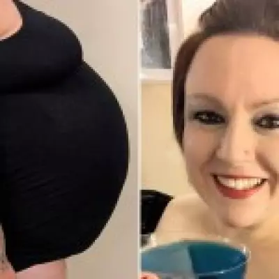 Woman's 12kg Cancerous Tumour Mistaken for Mounjaro Weight Loss Failure