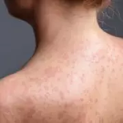 Measles Outbreak Infects Over 60 Children in North London Schools