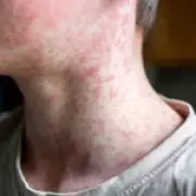 Measles Outbreak Spreads Across UK: London and West Midlands Become Hotspots