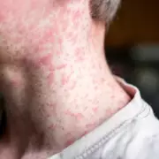 North London Measles Outbreak Exceeds 60 Cases as Vaccination Rates Lag