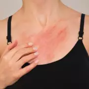 Scabies Surge: Expert Advice on Eradicating the Contagious Skin Condition