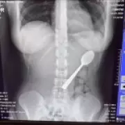Woman Accidentally Swallows 17cm Spoon After Dog Startles Her
