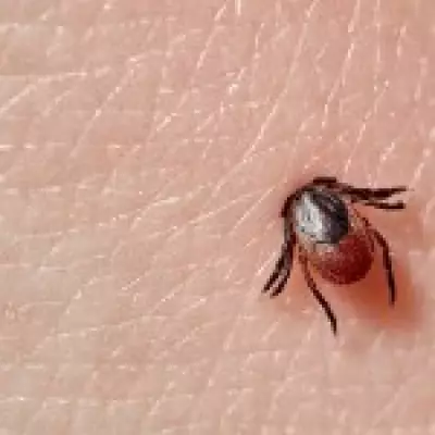 Alpha-Gal Syndrome: The Rising Threat of Tick-Borne Meat Allergy