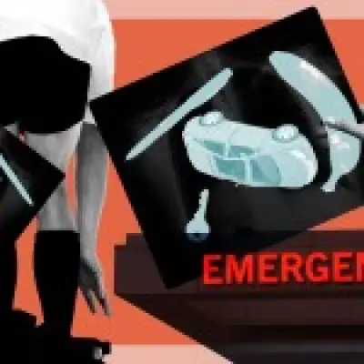 Why Men Over 50 Are More Prone to Rectal Object Mishaps