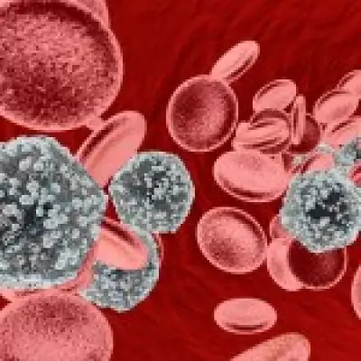 World First: HIV Patient Cured Through Brother's Stem Cell Transplant