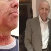 Dormant STI from Oral Sex Triggered Life-Threatening Throat Cancer After 30 Years