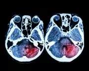 NHS Fails to Deliver 24/7 Stroke Treatment Across England Despite Promises