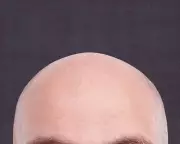 Reddit's r/bald Community: A Beacon of Support for Hair Loss and Self-Acceptance