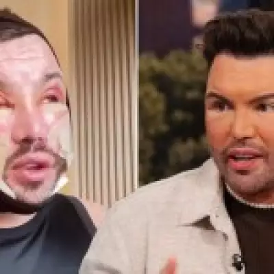 Bobby Norris Shows Swollen Facelift in New Video, Sparks Fan Confusion