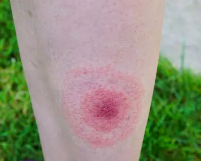 Lyme Disease Cases in England Surge Over 20% in a Year