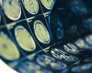 Lacunar Stroke Cause Found: Artery Widening, Not Blockage