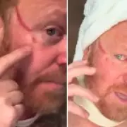 Leigh Francis Shows Horrific Facial Gash Caused by Fan's Fingernail