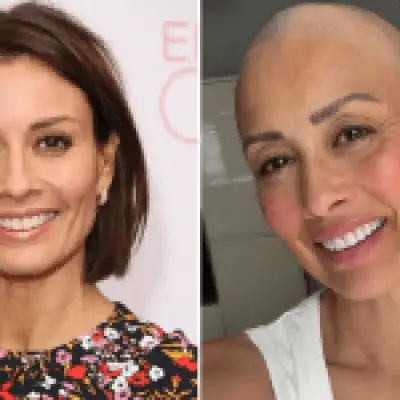 Melanie Sykes debuts fully bald look after alopecia hair loss