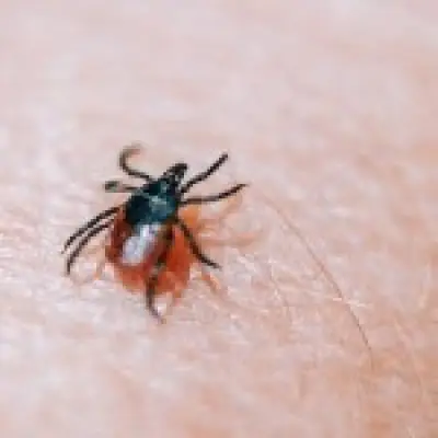 Tick bite could trigger life-threatening meat allergy, cases rising