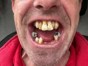 London man with 12 unsalvageable teeth quoted £60k finds dental solution abroad