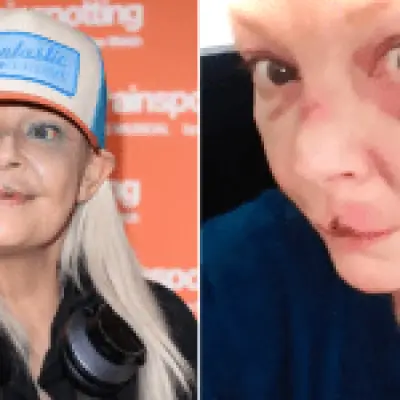 Gail Porter suffers black eye after being knocked down Tube stairs