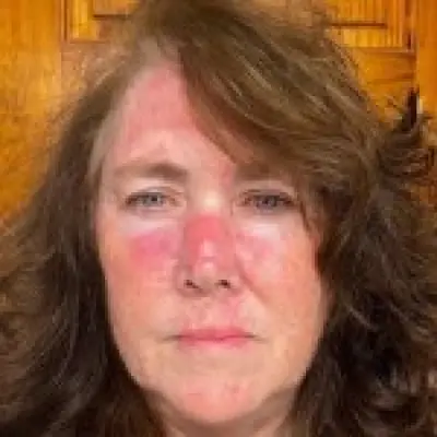 Shocking photos reveal mum-of-one's skin cancer ordeal after sunbathing