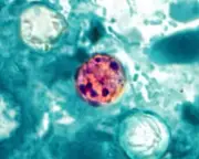 Cyclospora Outbreaks Causing Diarrhea in US Expected Through August
