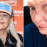 Gail Porter suffers black eye after being knocked down Tube stairs