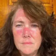 Shocking photos reveal mum-of-one's skin cancer ordeal after sunbathing