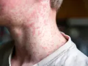 UK adult dies from measles as London cases surge: check symptoms
