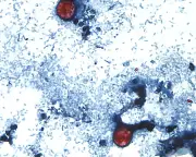 US Cyclospora Outbreak Exceeds 2,800 Cases Amid Public Health Funding Cuts
