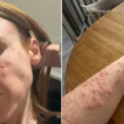 Travelodge guest wakes up covered in 100 bedbug bites after one night