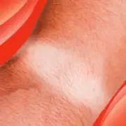 Watch Rot: The Summer Skin Condition Mistaken for Tan Lines