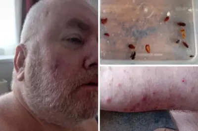 Bedbug invasion leaves Eltham man with over 1,000 bites
