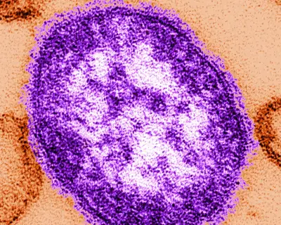 Six-week-old dies from measles in Pennsylvania, coroner says