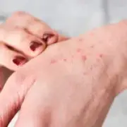 Harvest mites thriving in UK as autumn conditions trigger bites