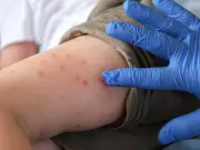 Measles cases 2026: Enfield worst hit with 111 infections